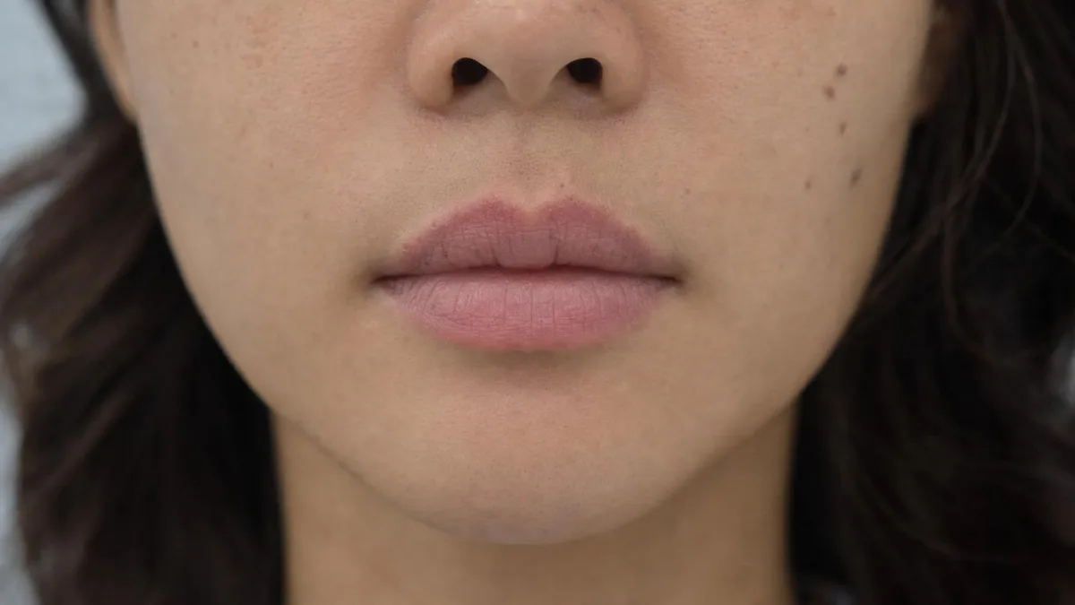 korean-lip-filler-restylane-kysse-foreign-patients-guide related image