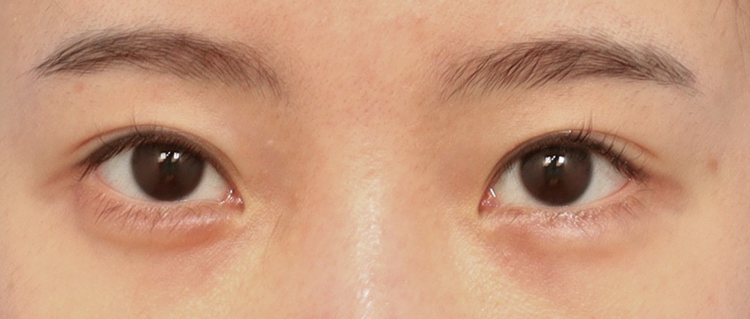 Double Eyelid Before