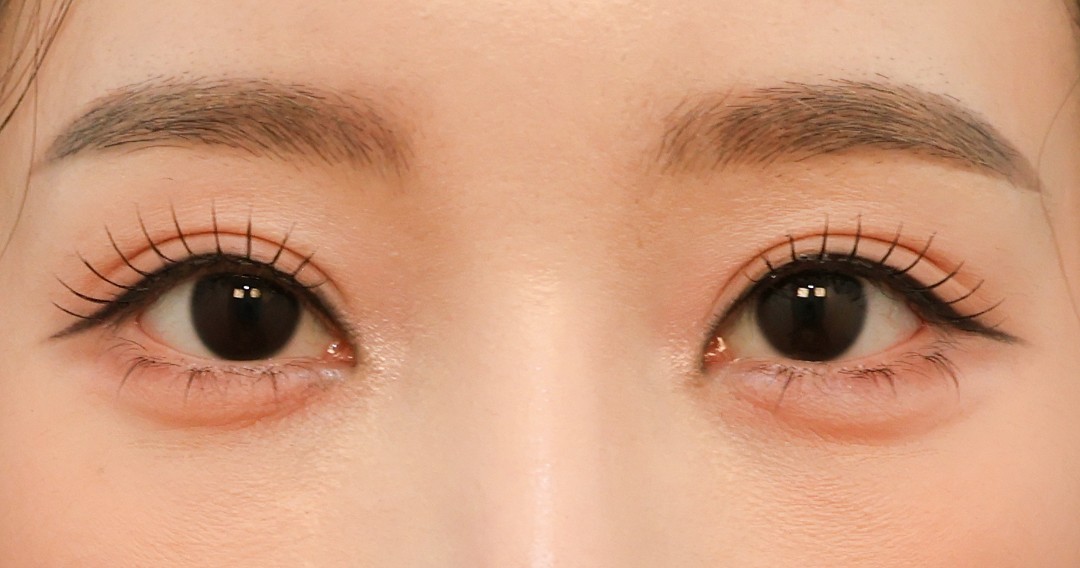 Double Eyelid After
