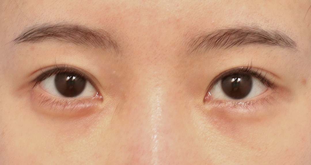 Double Eyelid Before