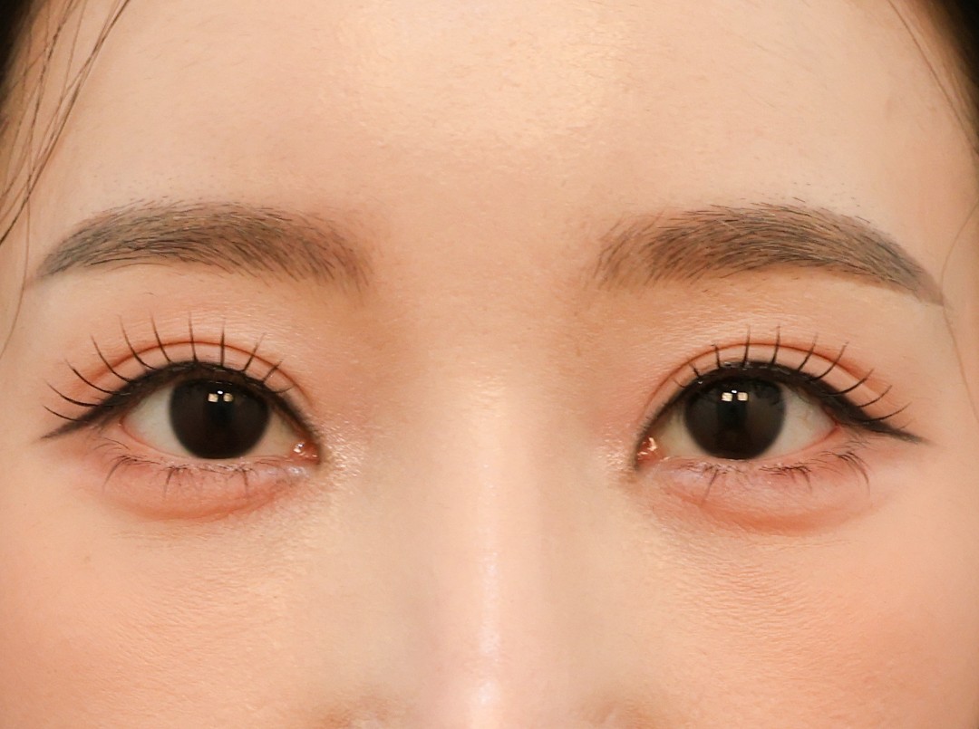 Double Eyelid After