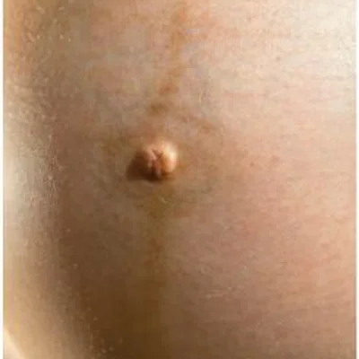 Post-Pregnancy Deformity