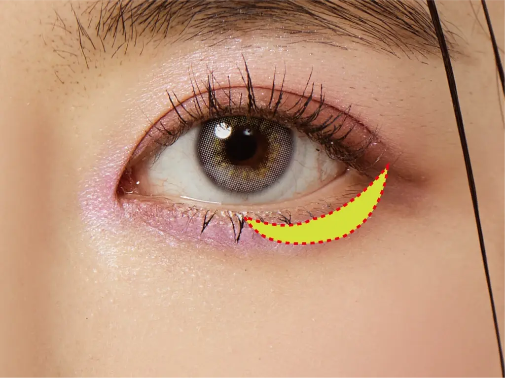 下眼瞼下制（たれ目形成）