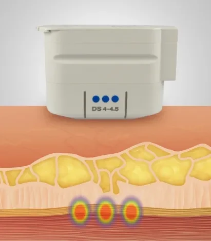 Focused ultrasound treatment