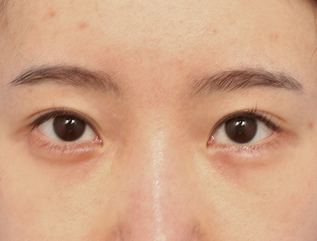 Phẫu thuật mí đôi — Trước